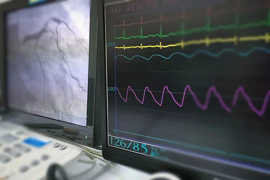 Electrocardiogram monitor displaying heart rhythm waveforms